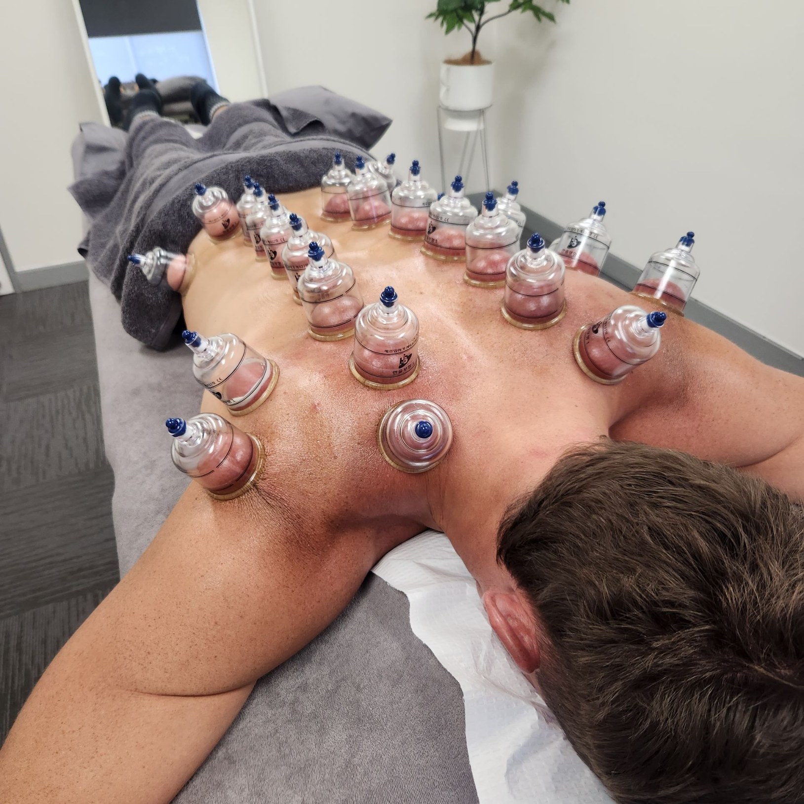 Cupping therapy at Active Balance Physio & Wellness