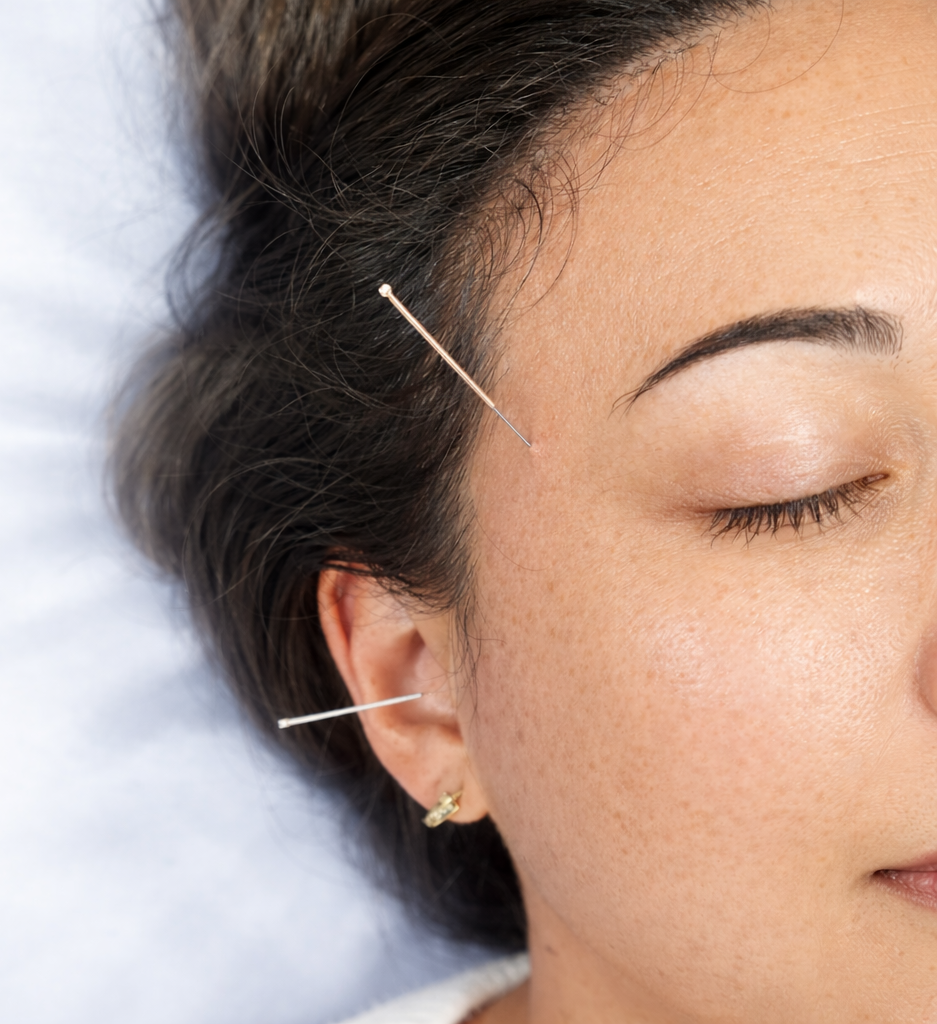 physiotherapist performing facial dry needling at Active Balance