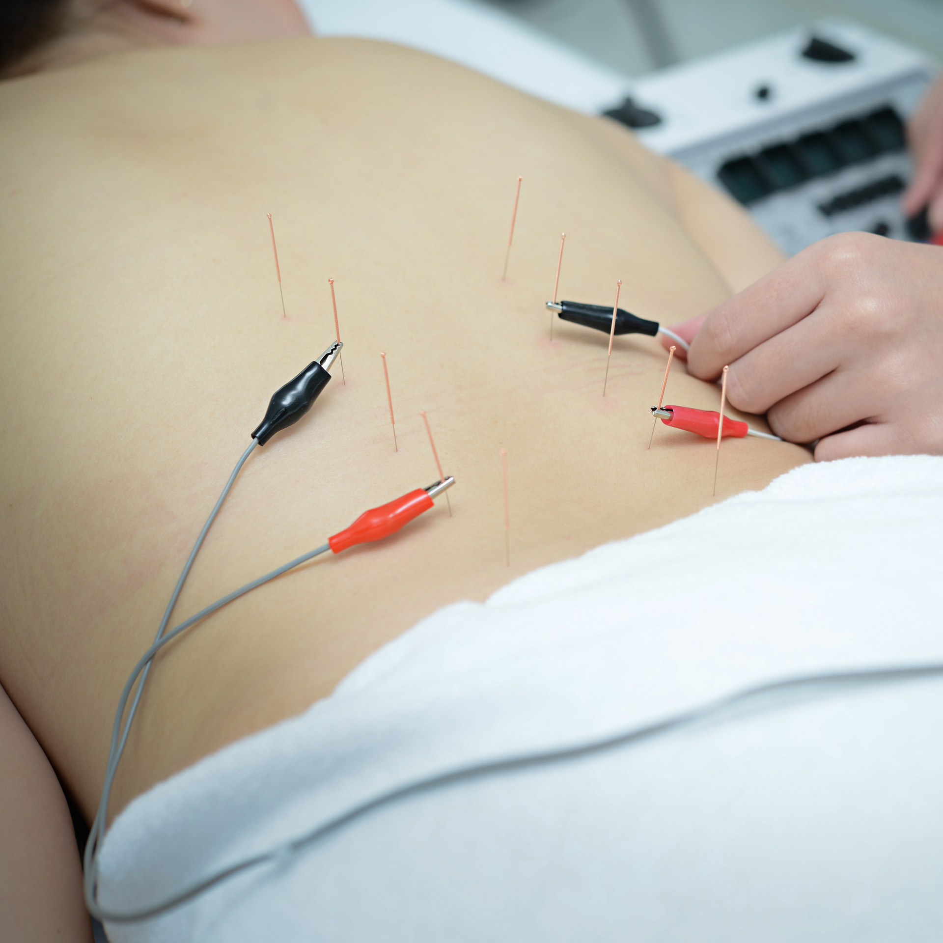 physio applying electroneedling Active Balance Physio & Wellness