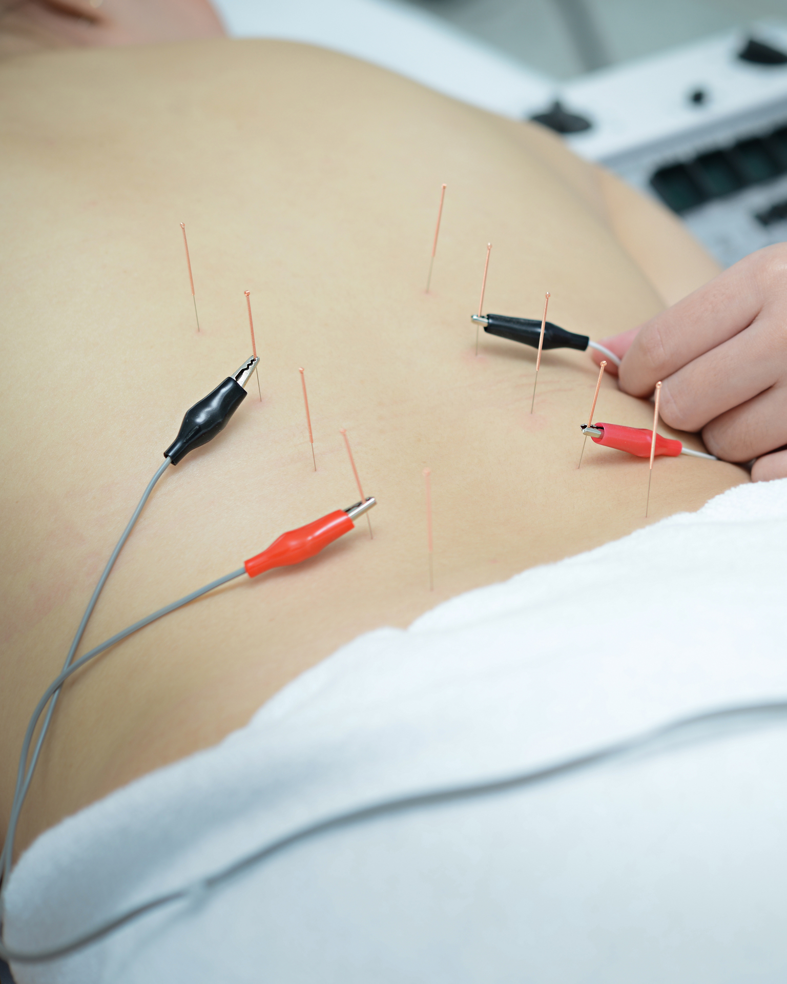 physiotherapist performing electrodryneedling for back pain