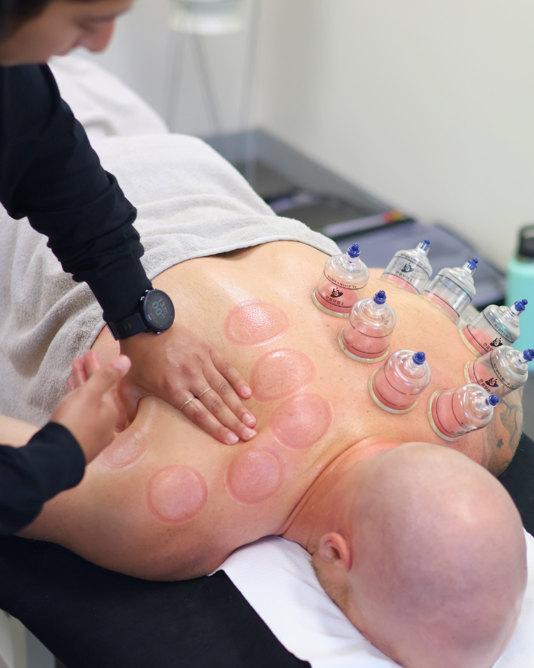 physiotherapist performing cupping treatment for shoulder pain