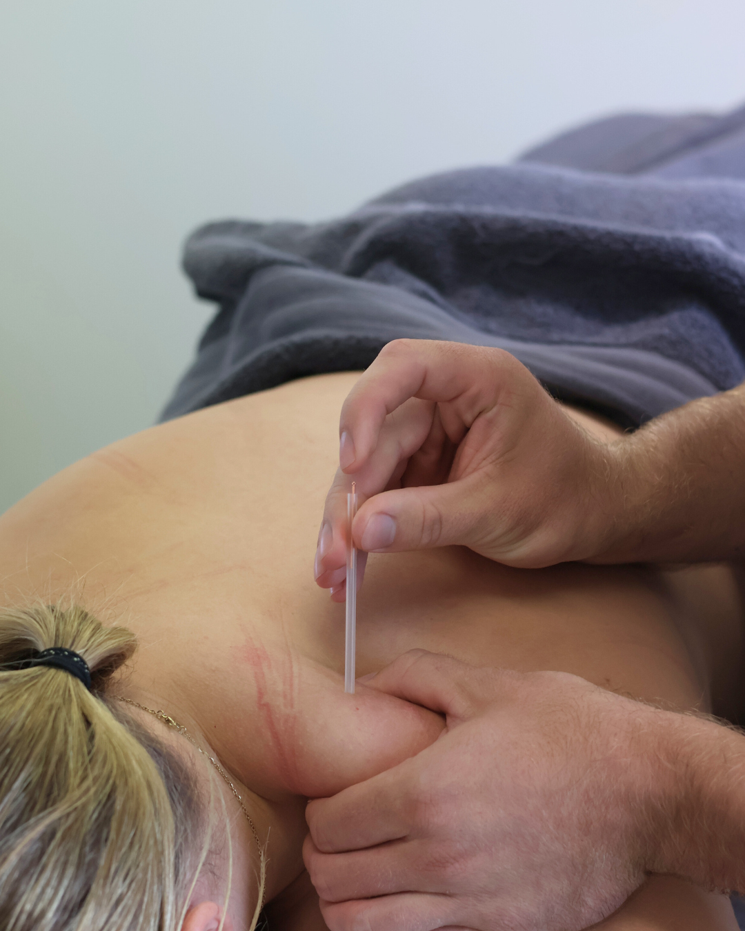 dry needling near me