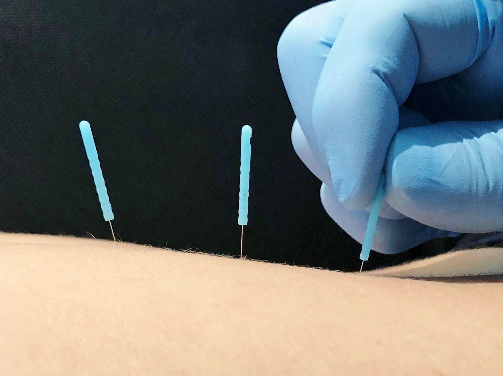 Physiotherapist applying dry needling