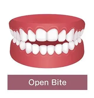 Example of Open Bite Problem