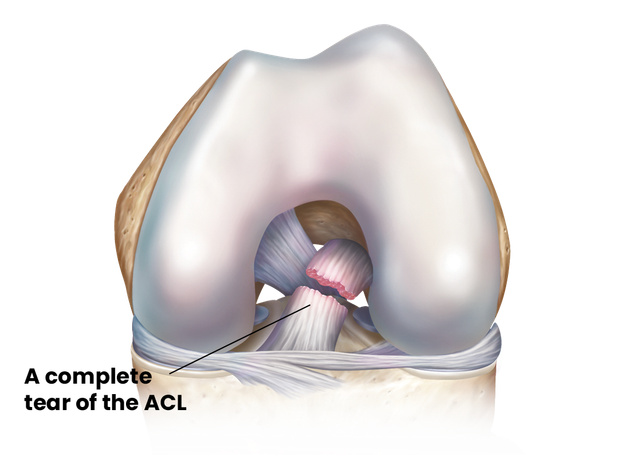 Can ACL Injuries Self-heal and Can you Become a 'Coper' ?