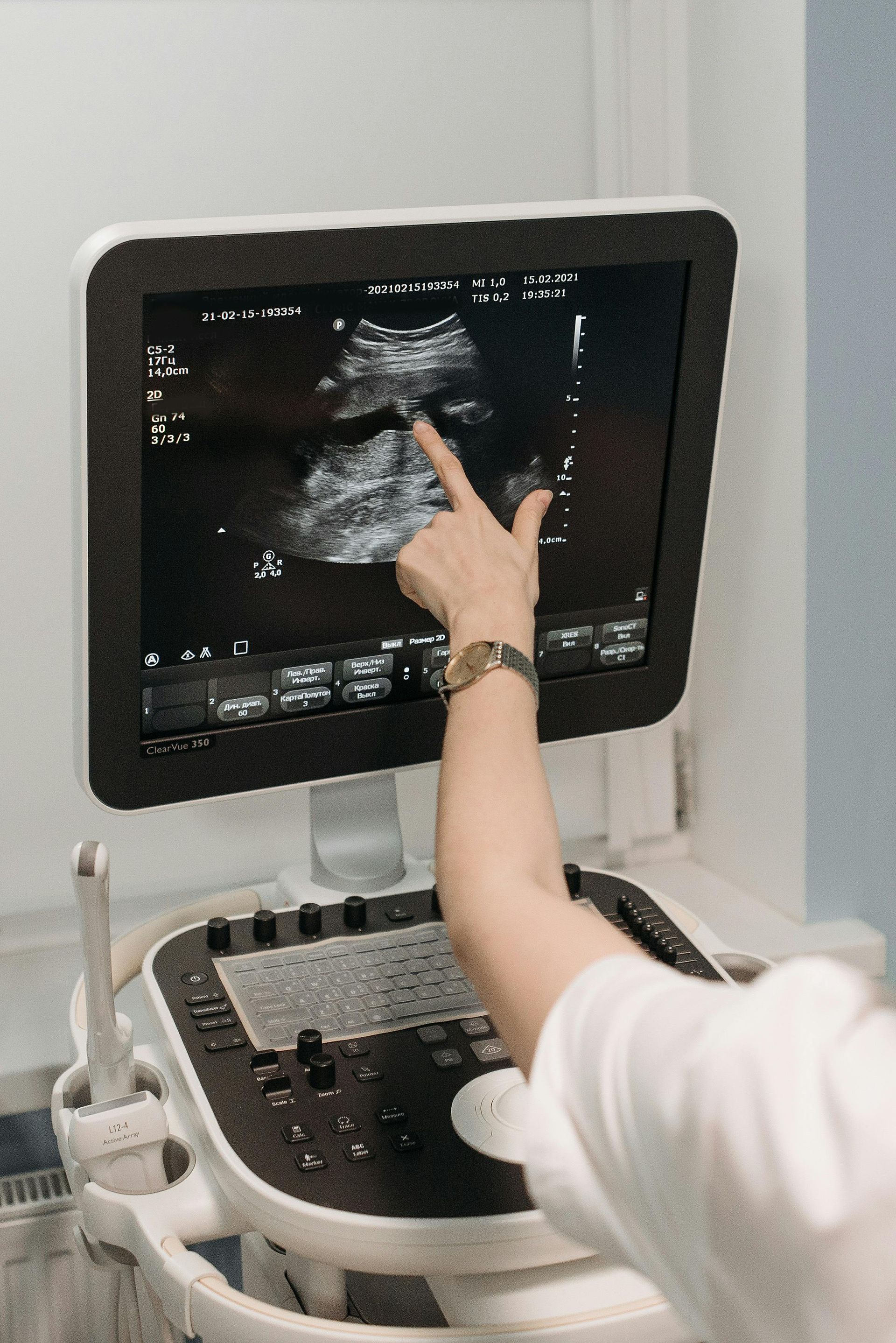 A person is pointing at an ultrasound image on a computer screen.