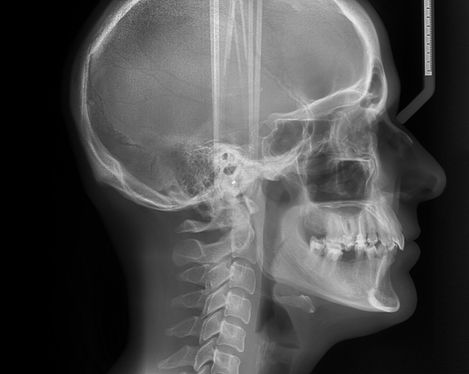 TELERADIOGRAFIA DEL CRANIO