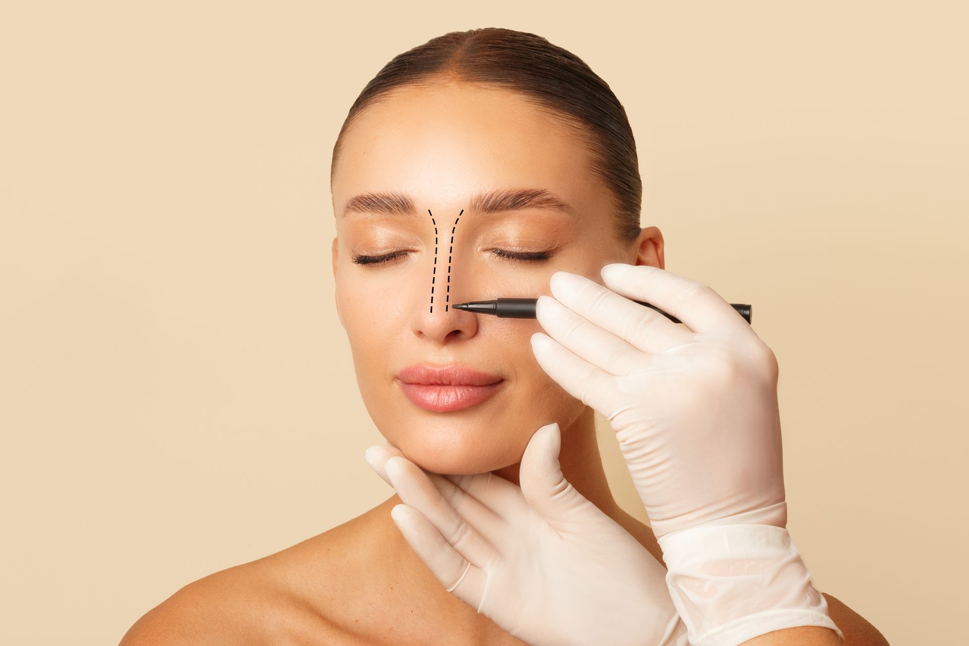 A person's face with dotted lines on nose as a doctor preps for nose surgery.