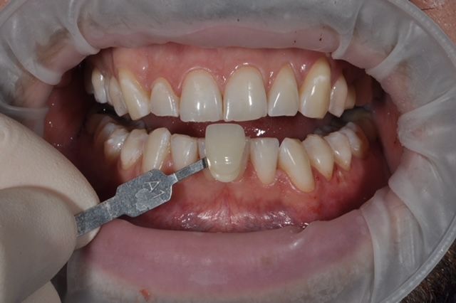 Dentista che applica il gel sbiancante ai denti anteriori inferiori con una spazzola e un divaricatore per le guance