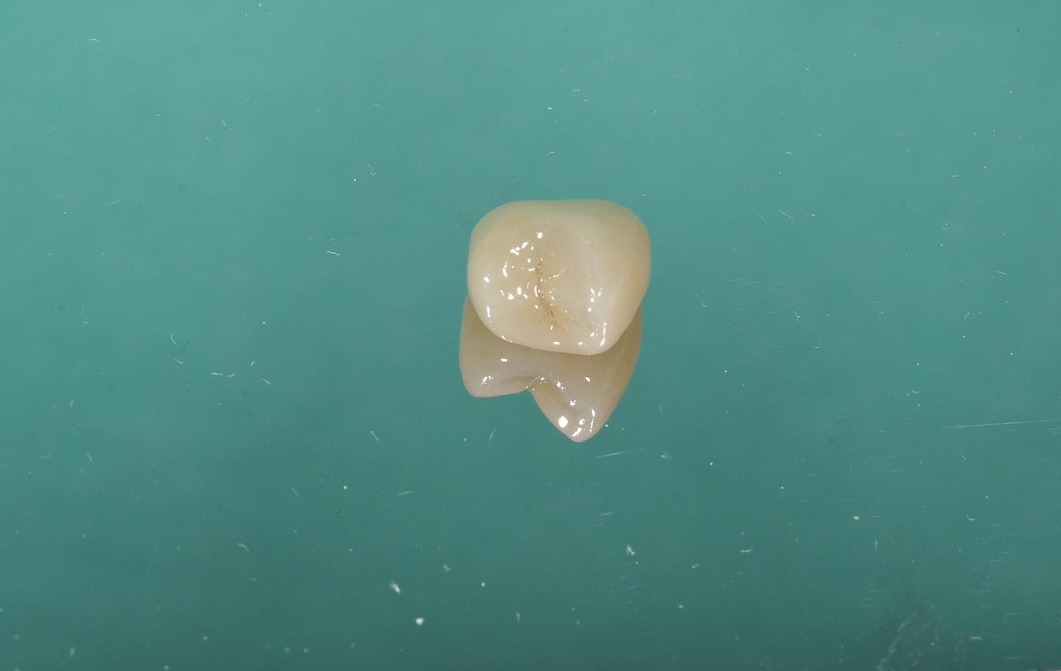 Un singolo dente su una superficie dentale color verde acqua, mostrato in primo piano con la radice visibile.