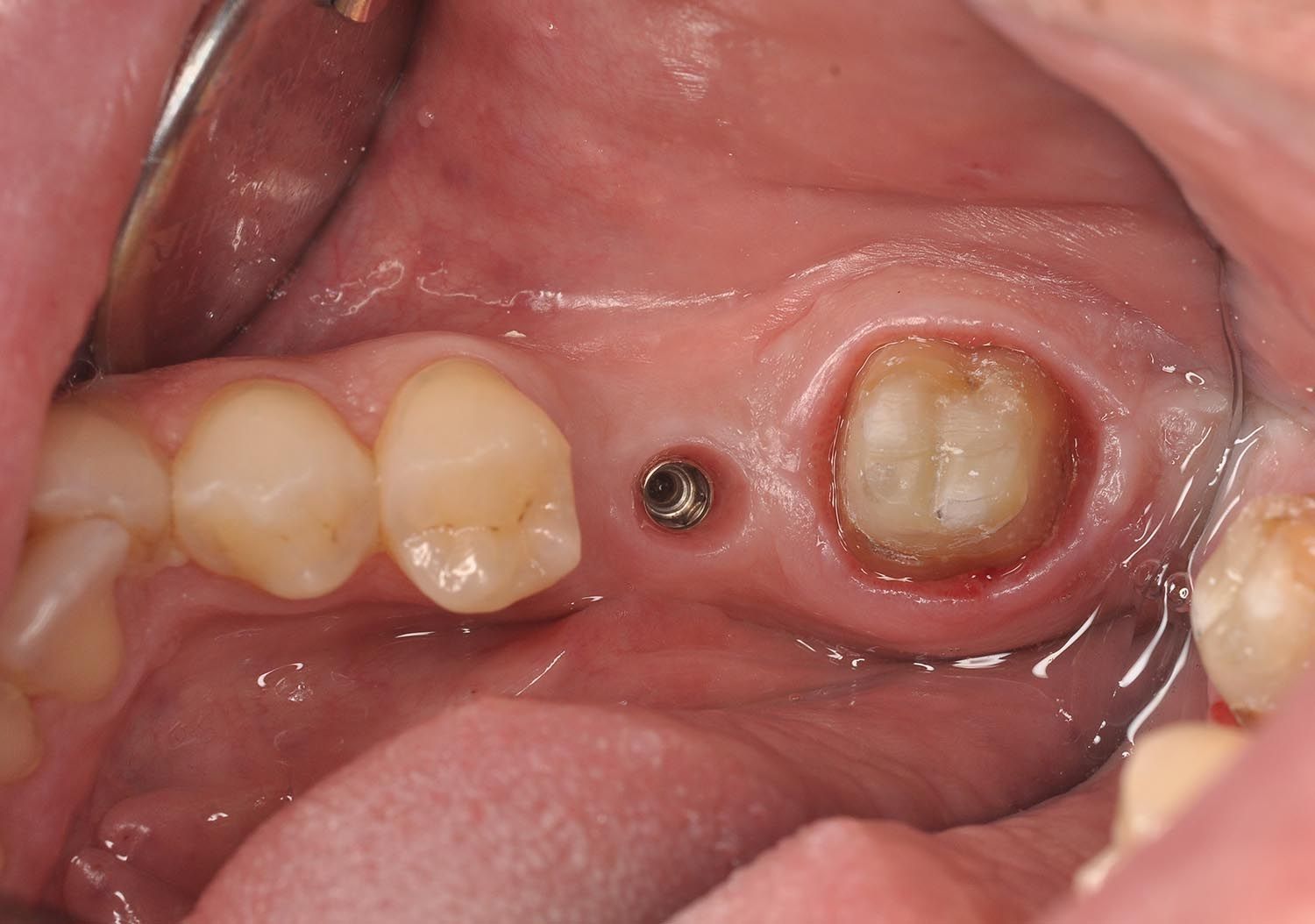 Primo piano delle gengive superiori con impianti dentali e denti adiacenti all'interno di una bocca