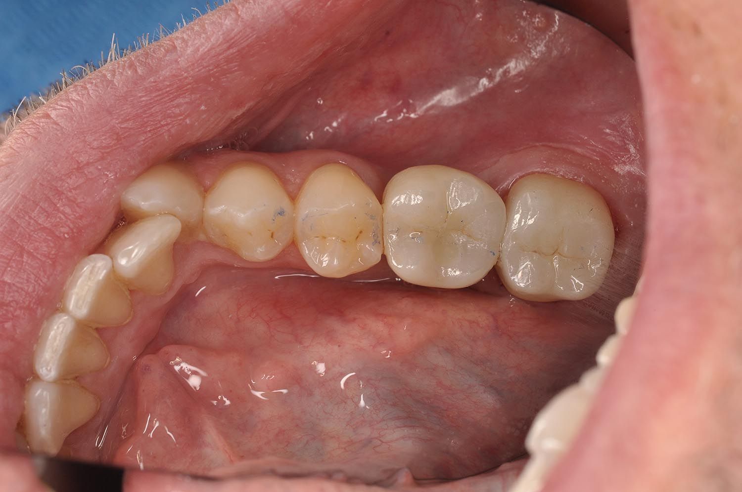Primo piano dei denti superiori e della lingua all'interno di una bocca aperta, che mostra otturazioni e gengive.