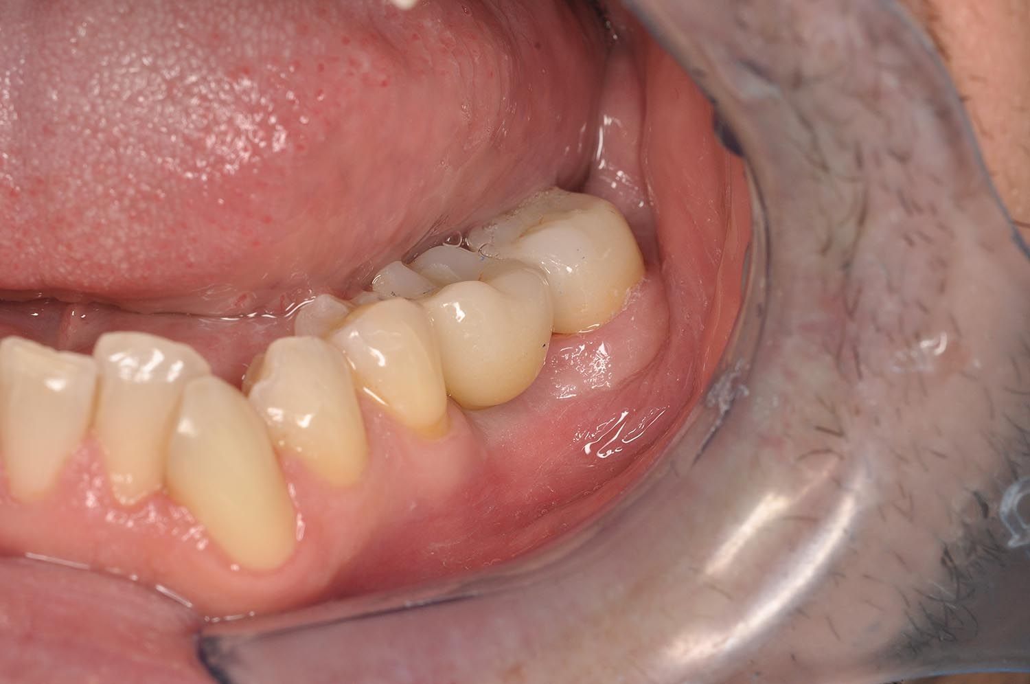 Primo piano di denti e gengive inferiori con colorazione giallastra all'interno di un divaricatore orale.