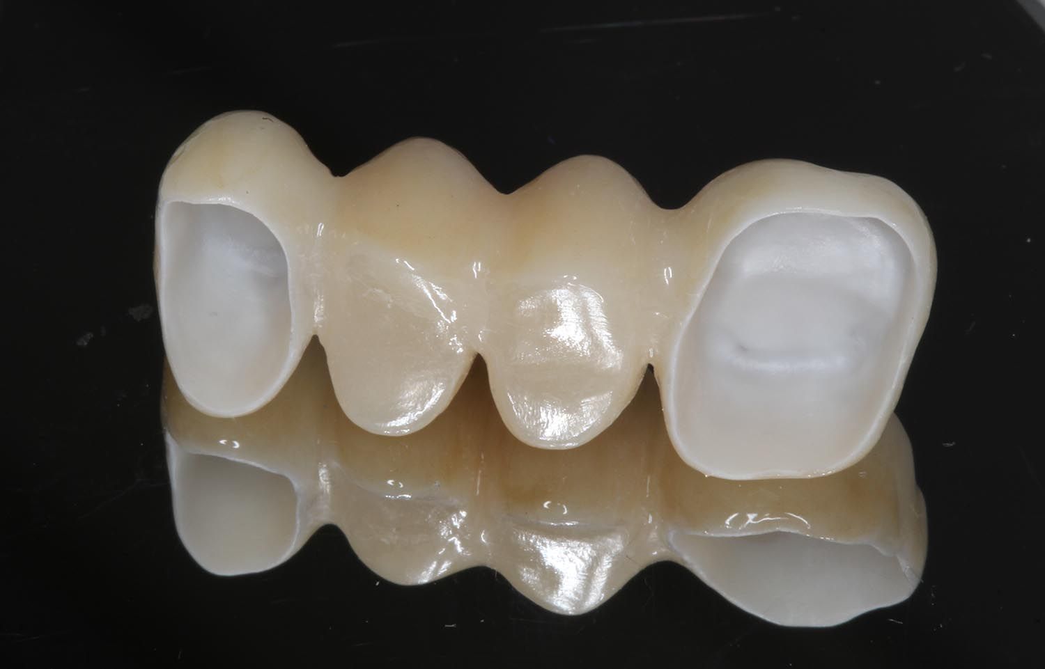 Ponte dentale beige con tre elementi intermedi e due corone terminali su sfondo nero.