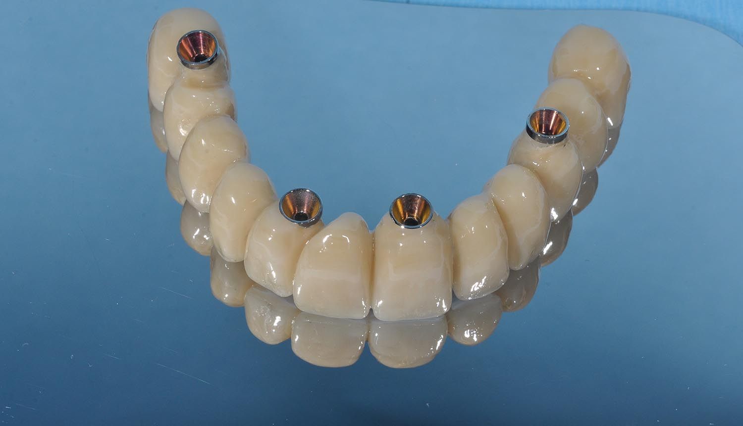 Arcata dentale con denti bianchi e attacchi metallici su sfondo blu