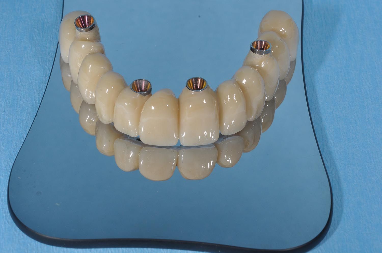Protesi dentale curva su una superficie blu, che mostra denti color crema e perni metallici.
