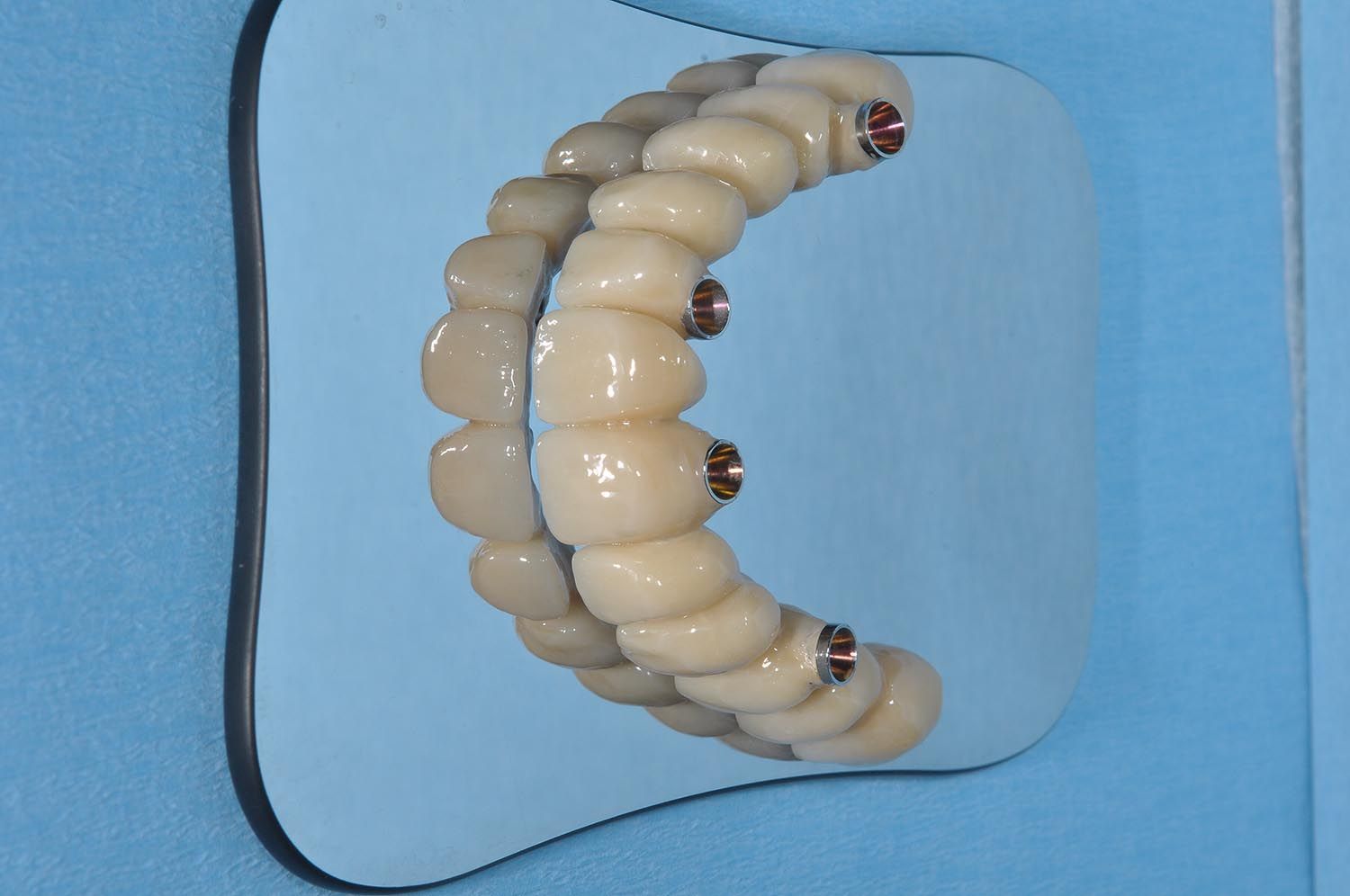 Primo piano di un calco dentale con denti bianchi su sfondo blu.