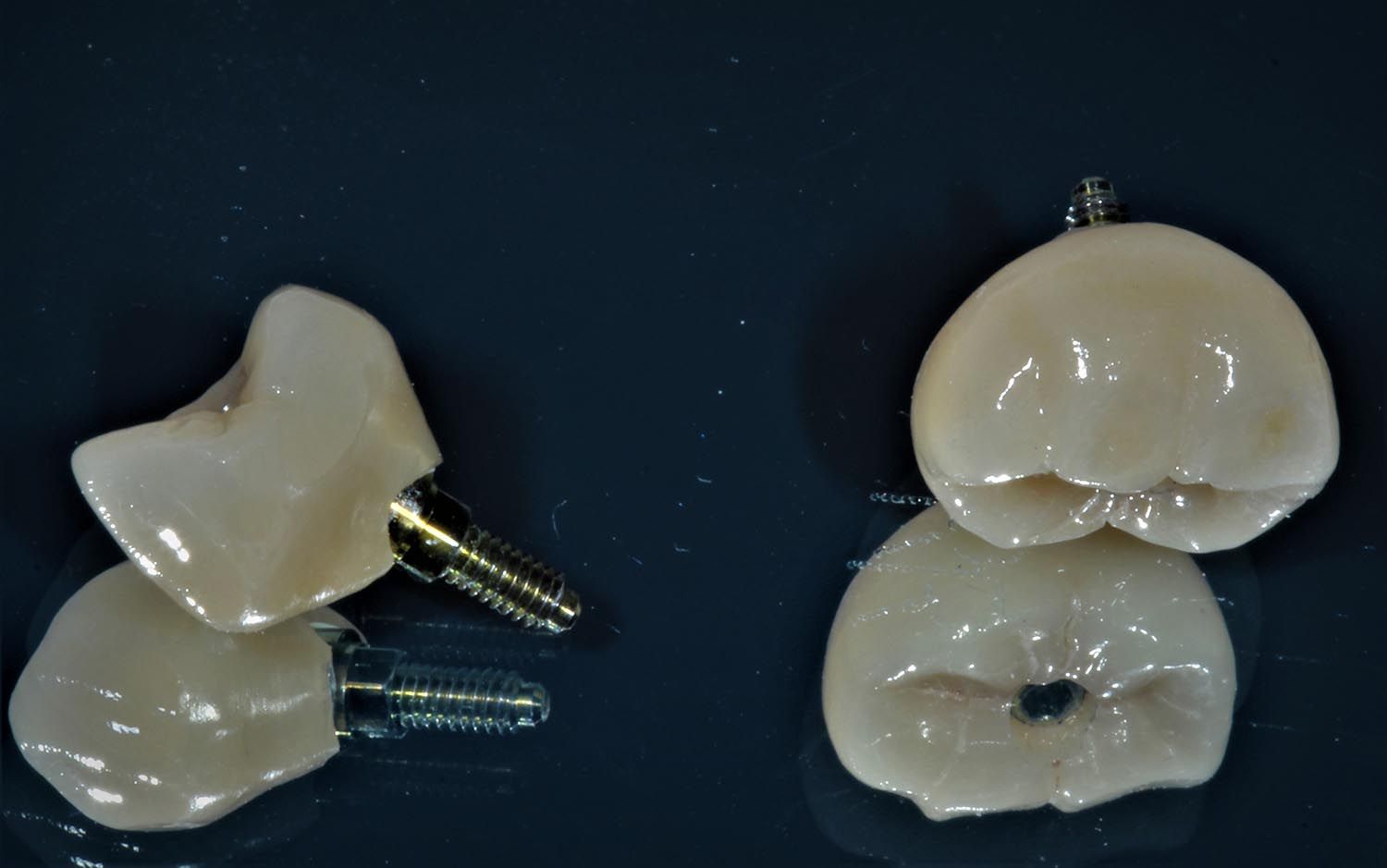Componenti di impianti dentali e corone bianche a forma di dente disposte su uno sfondo scuro.