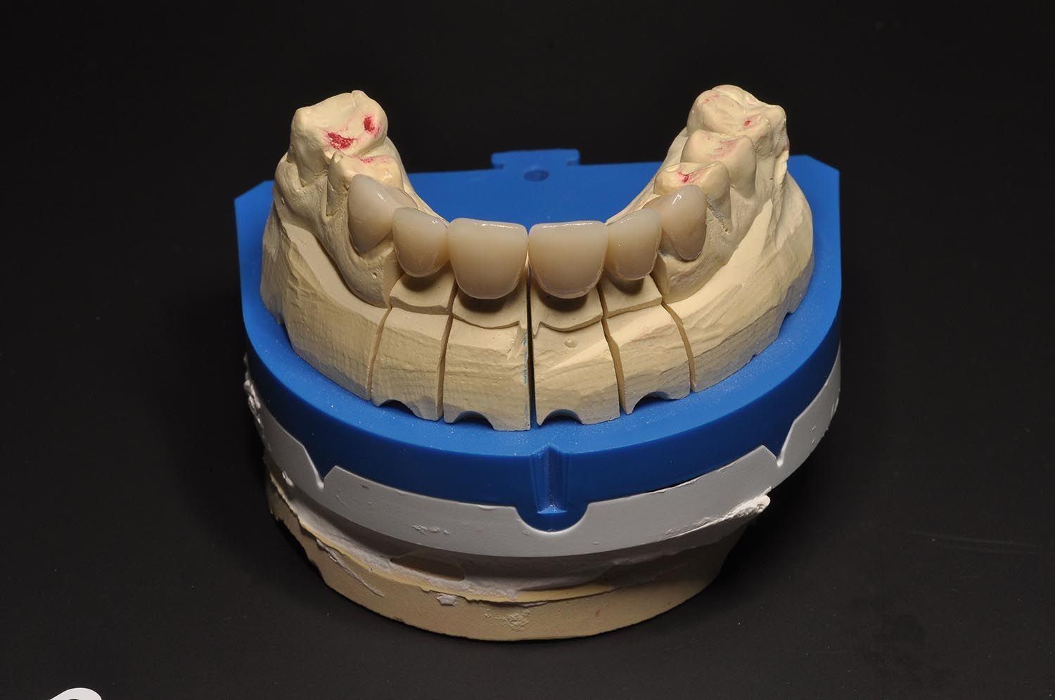 Calco dentale su base blu, raffigurante un'arcata superiore e una inferiore realizzate in gesso beige.