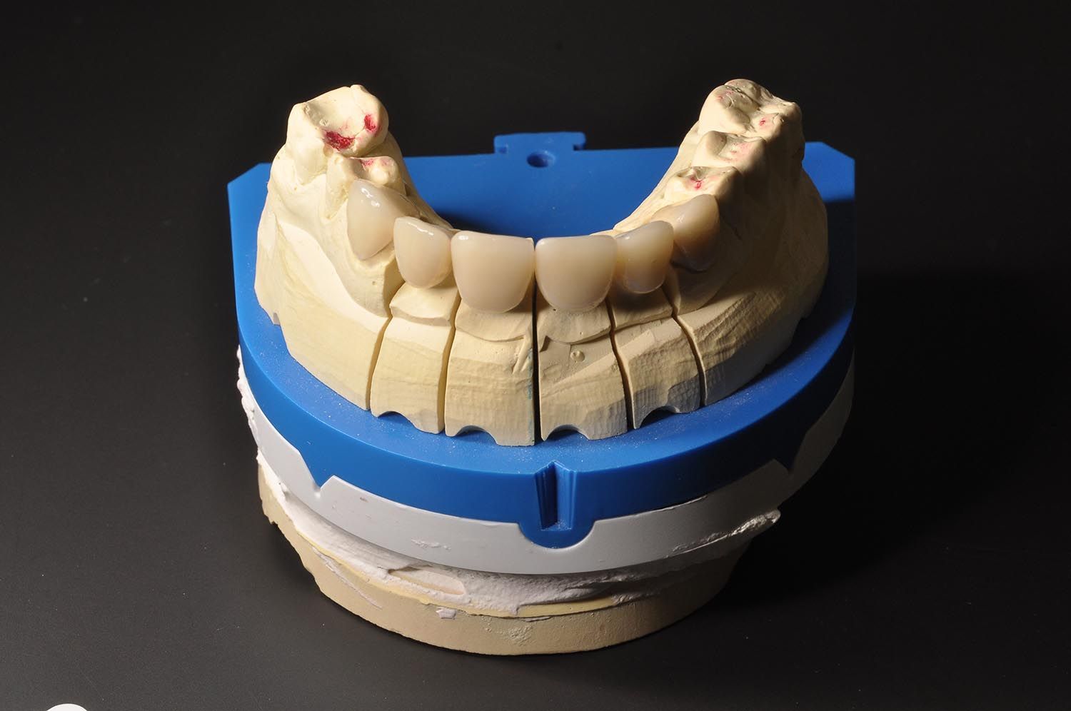Calco dentale in un vassoio per impronte blu su sfondo nero