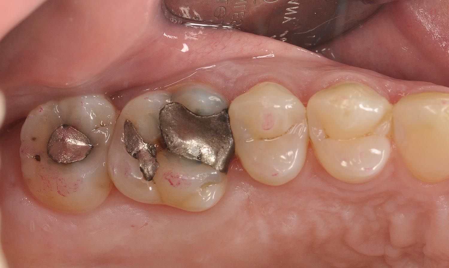 Primo piano di molari inferiori con otturazioni in amalgama d'argento e carie visibile.