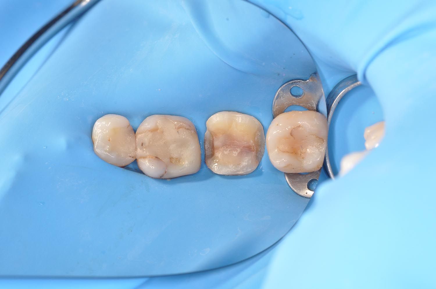 Primo piano di quattro denti isolati con diga dentale blu durante una procedura odontoiatrica.