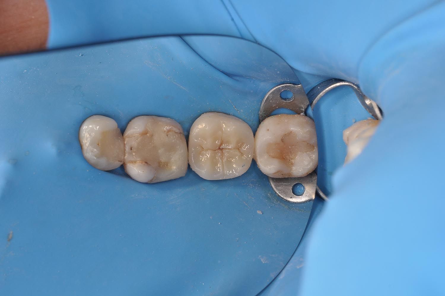 Quattro piccole corone dentali beige su diga di gomma blu con morsetto metallico per lavori di restauro.