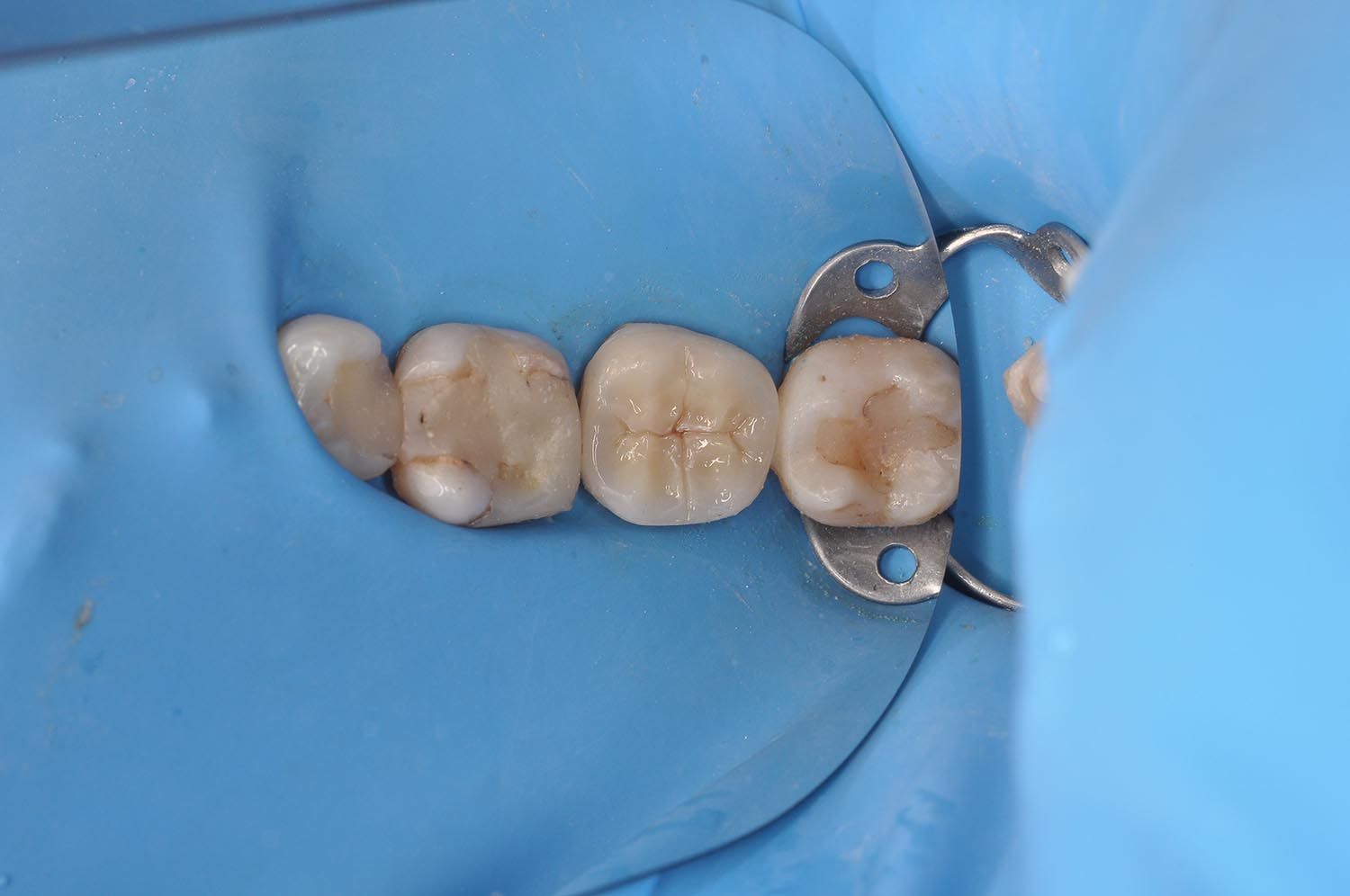 Primo piano di molari isolati con diga di gomma dentale blu e morsetto metallico.