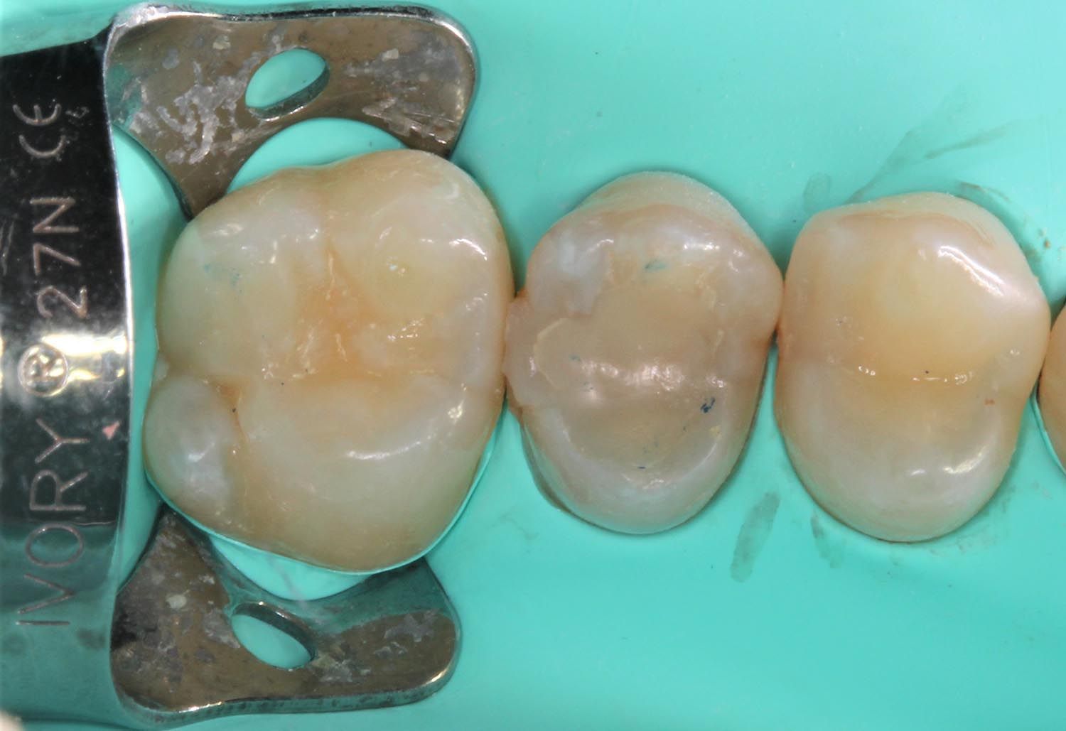 Primo piano dentale di tre denti isolati con una diga di gomma verde e un morsetto metallico.