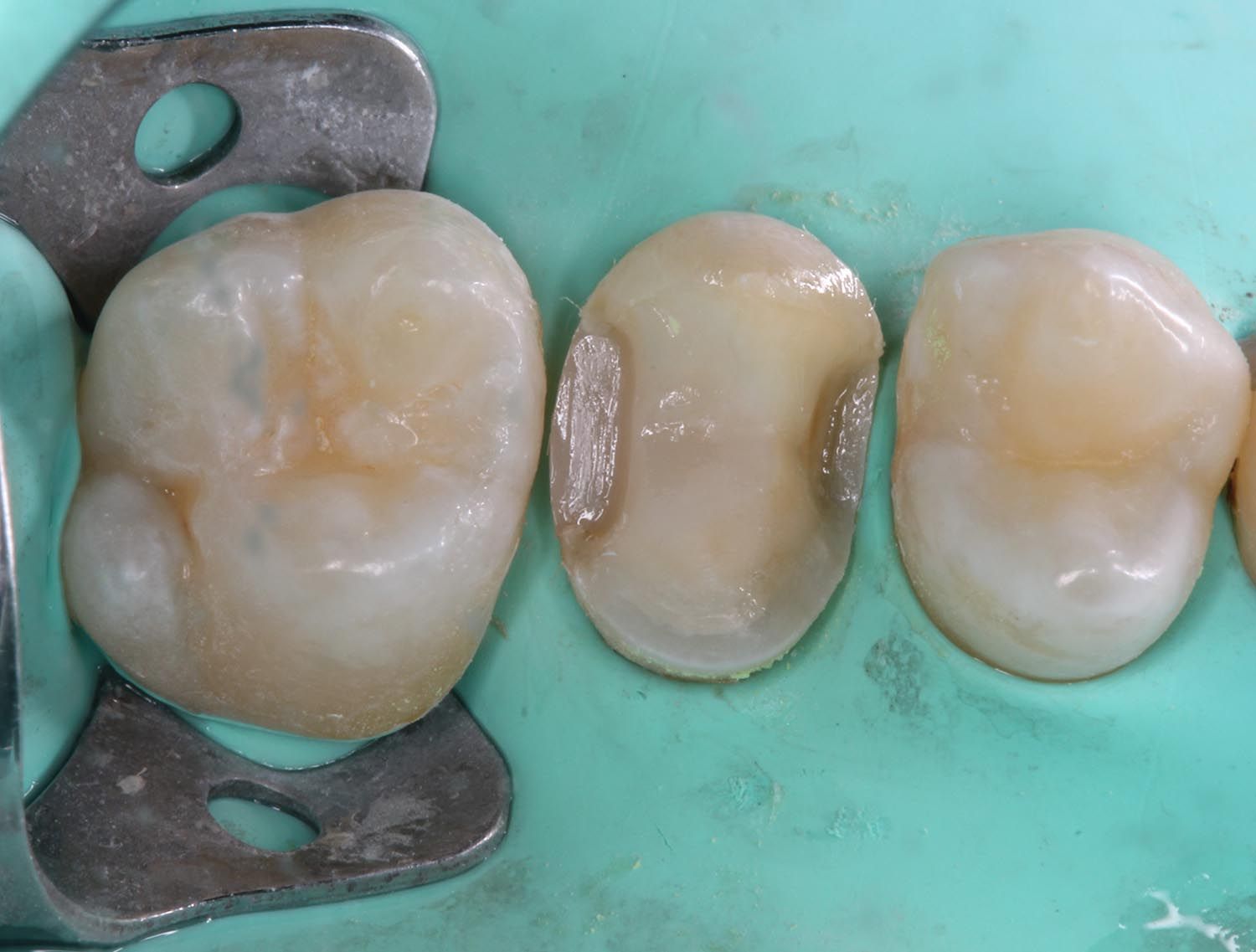 Primo piano dentale di tre molari isolati su una superficie verde, uno dei quali con un morsetto metallico attaccato