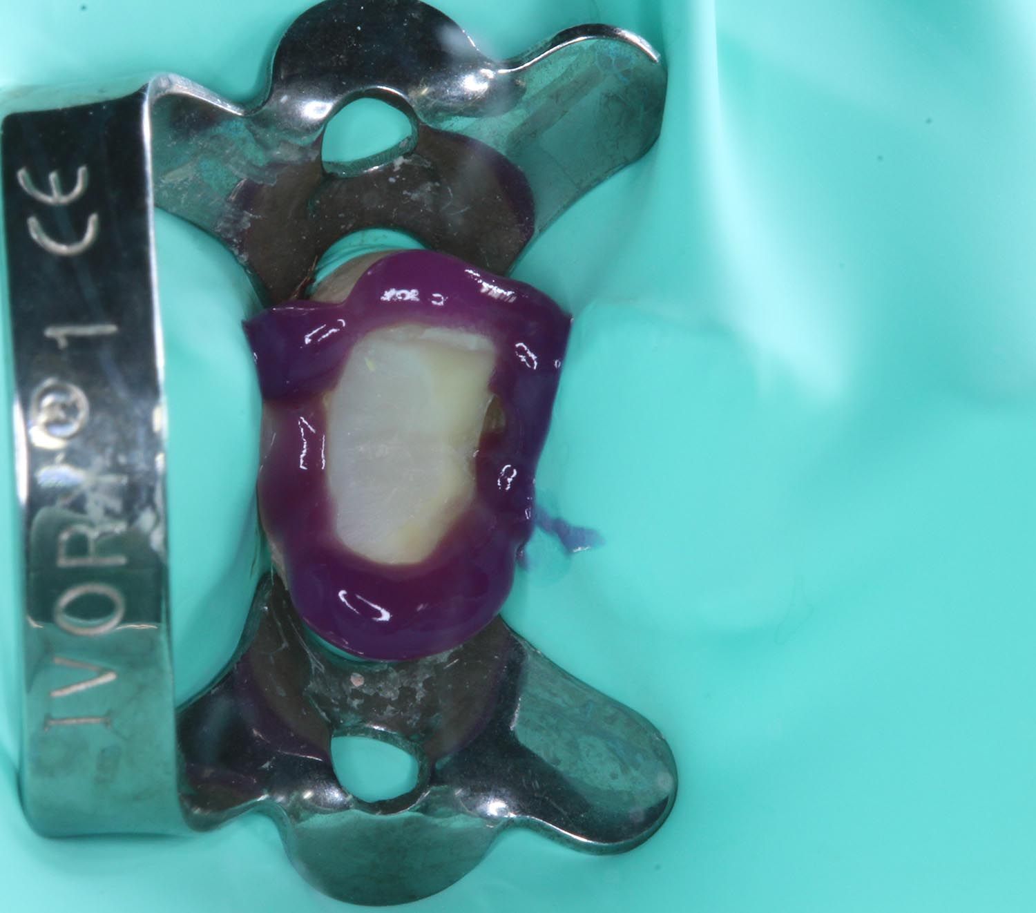 Morsetto dentale che tiene una diga di gomma viola attorno a un dente su sfondo verde acqua.