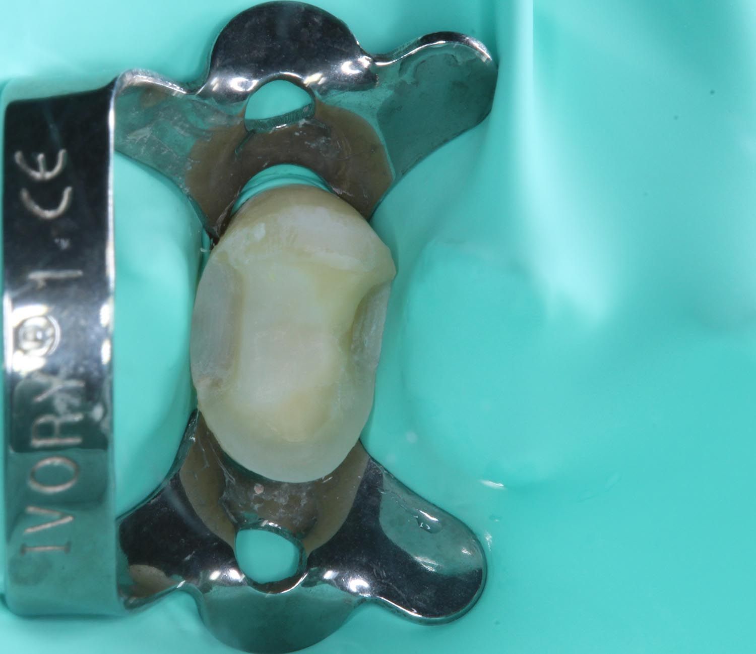 Dente dentale su un supporto metallico, isolato su sfondo turchese.