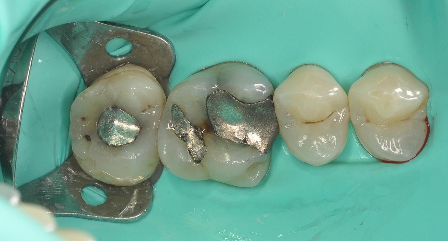 Primo piano di quattro denti isolati con una diga di gomma verde, che mostrano le otturazioni in amalgama d'argento e lo smalto naturale.
