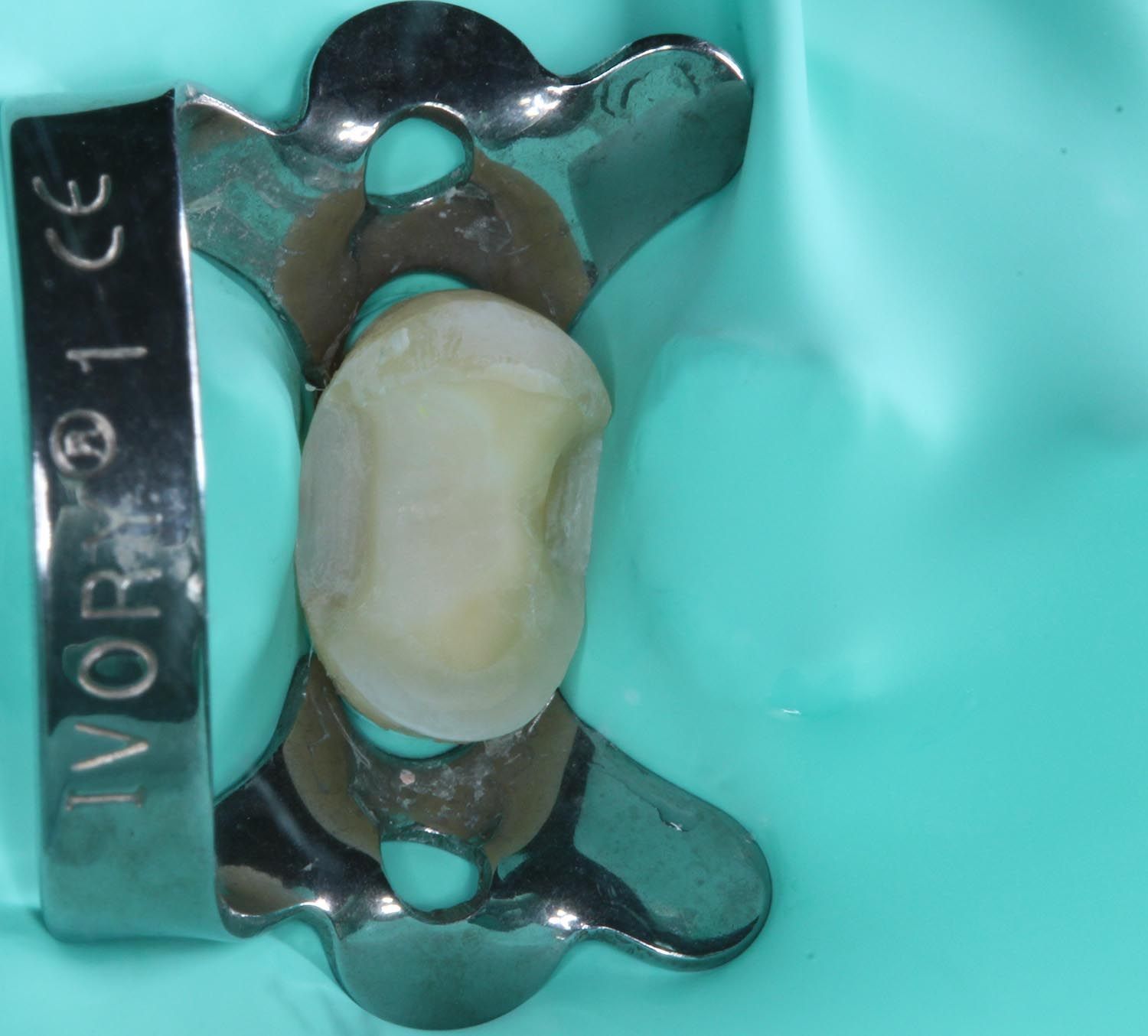 Calco dentale in un morsetto ortodontico metallico su sfondo turchese