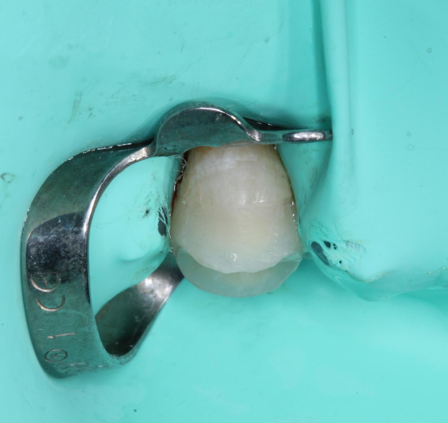 Dente dentale isolato con una pinza metallica e diga di gomma verde durante una procedura odontoiatrica.