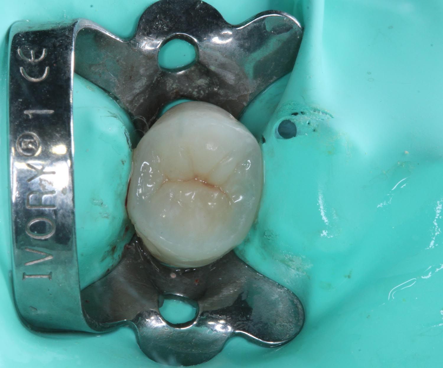 Primo piano dentale con una pinza metallica che tiene fermo un molare bianco su uno sfondo turchese.