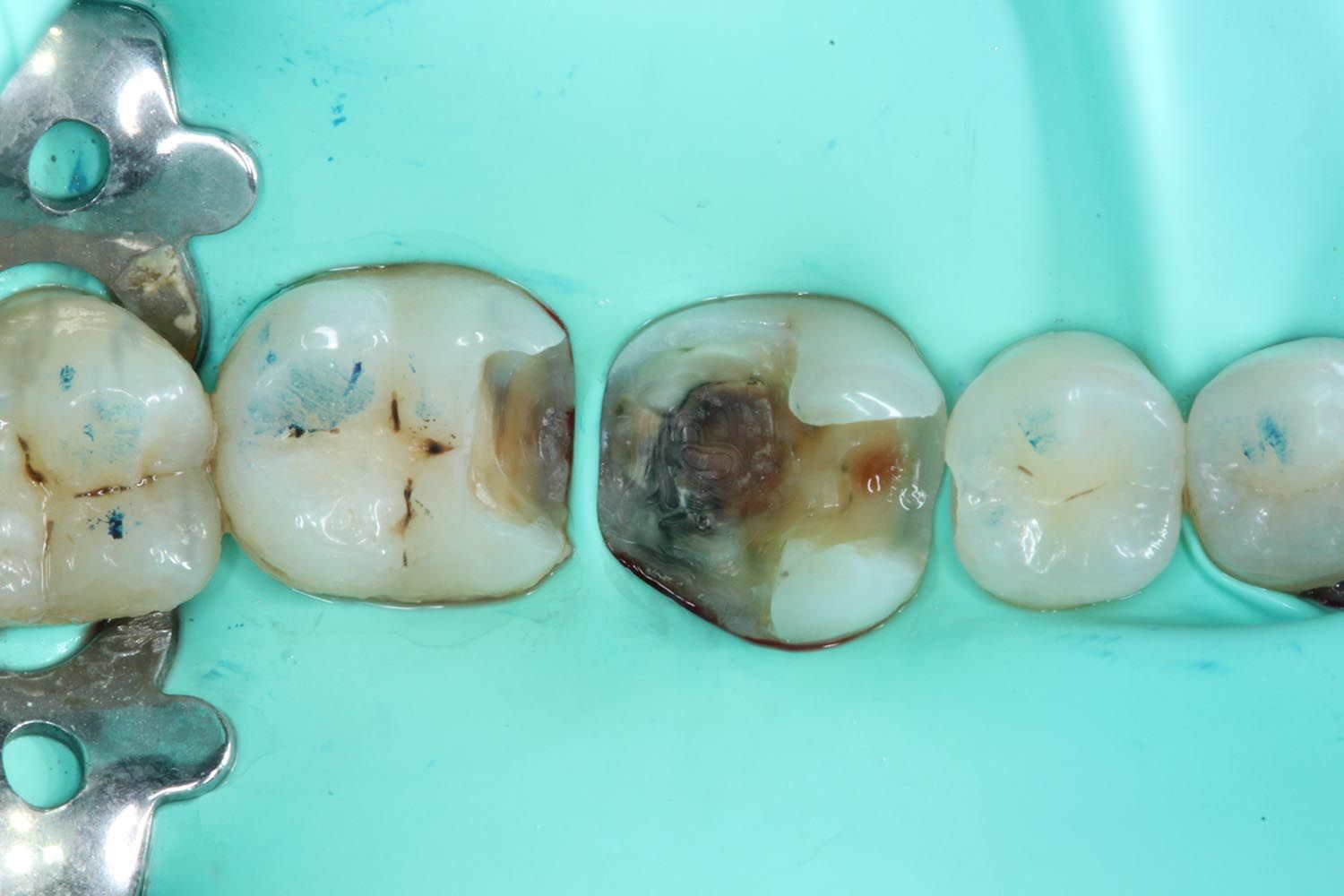 Primo piano di molari cariati isolati con una diga di gomma dentale