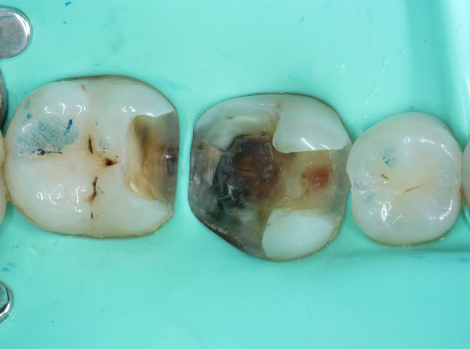Primo piano di tre denti con carie scure e isolamento tramite diga dentale.