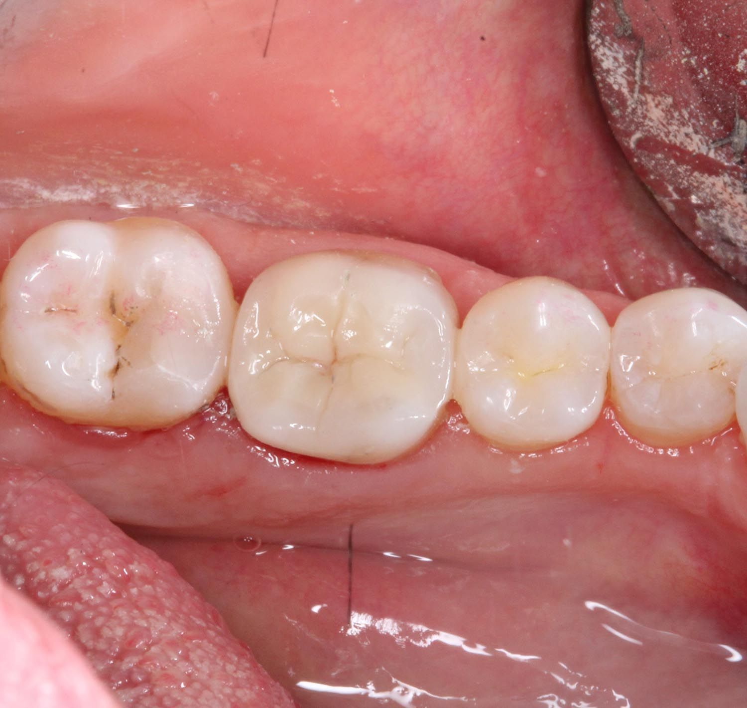 Primo piano di molari inferiori con otturazioni dentali visibili all'interno della bocca