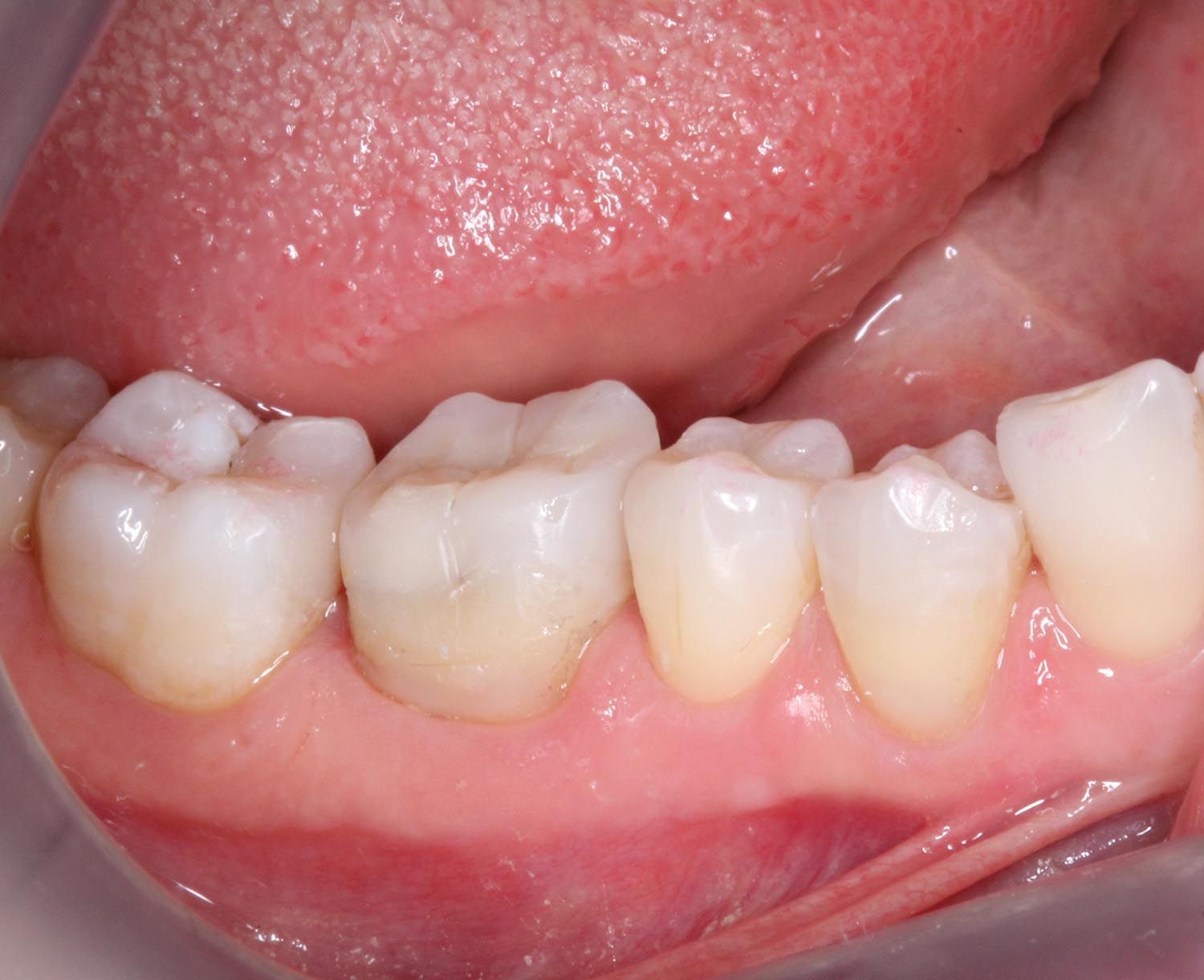 Primo piano dei denti incisivi inferiori con una macchia gengivale rosso-violacea e la lingua sopra.