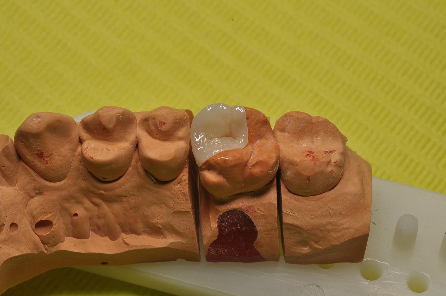 Calco dentale che mostra diversi denti, tra cui un incisivo mancante e un'otturazione trasparente su sfondo giallo.