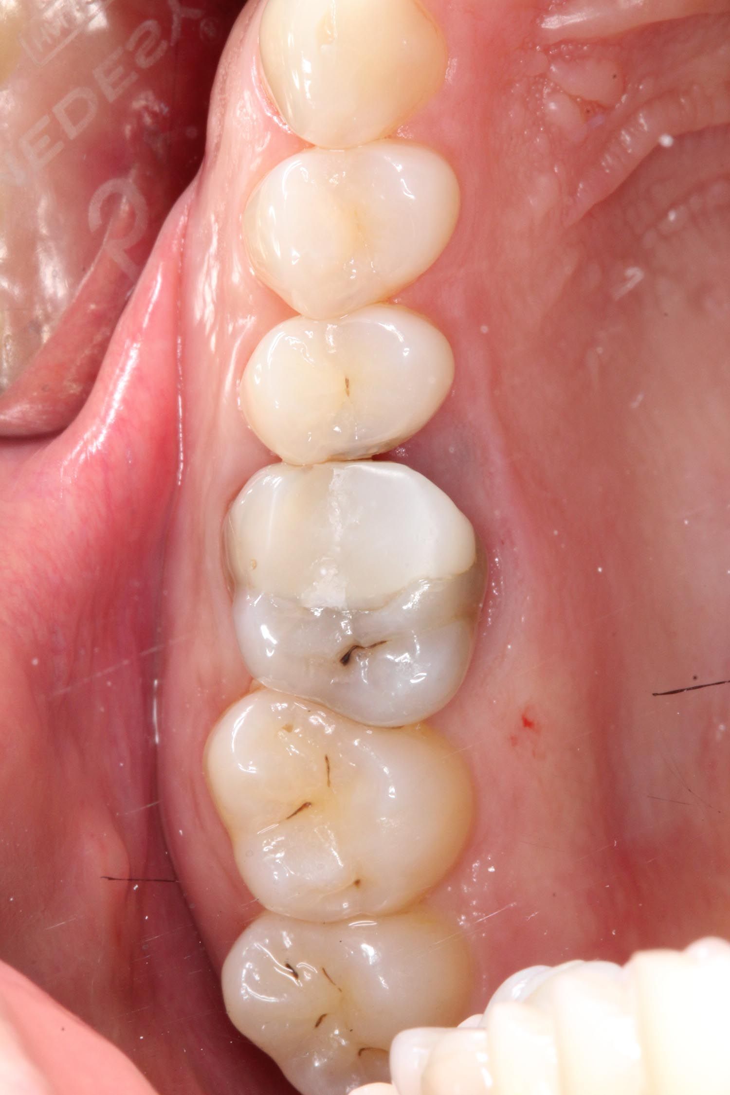 Primo piano di molari con un'otturazione dentale in amalgama d'argento nella zona superiore della bocca.