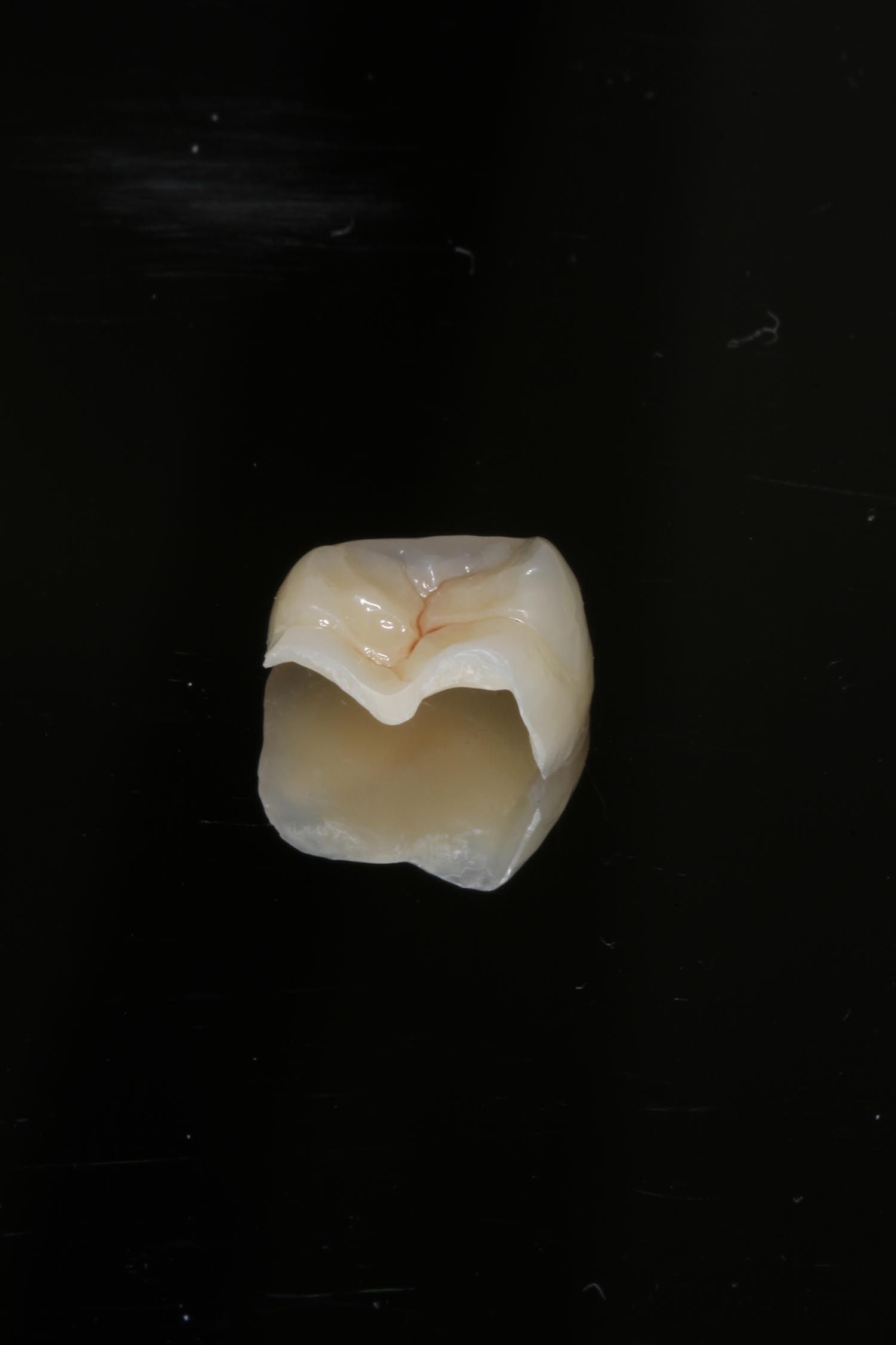 Dente singolo estratto su sfondo scuro, che mostra una corona scheggiata o cariata.