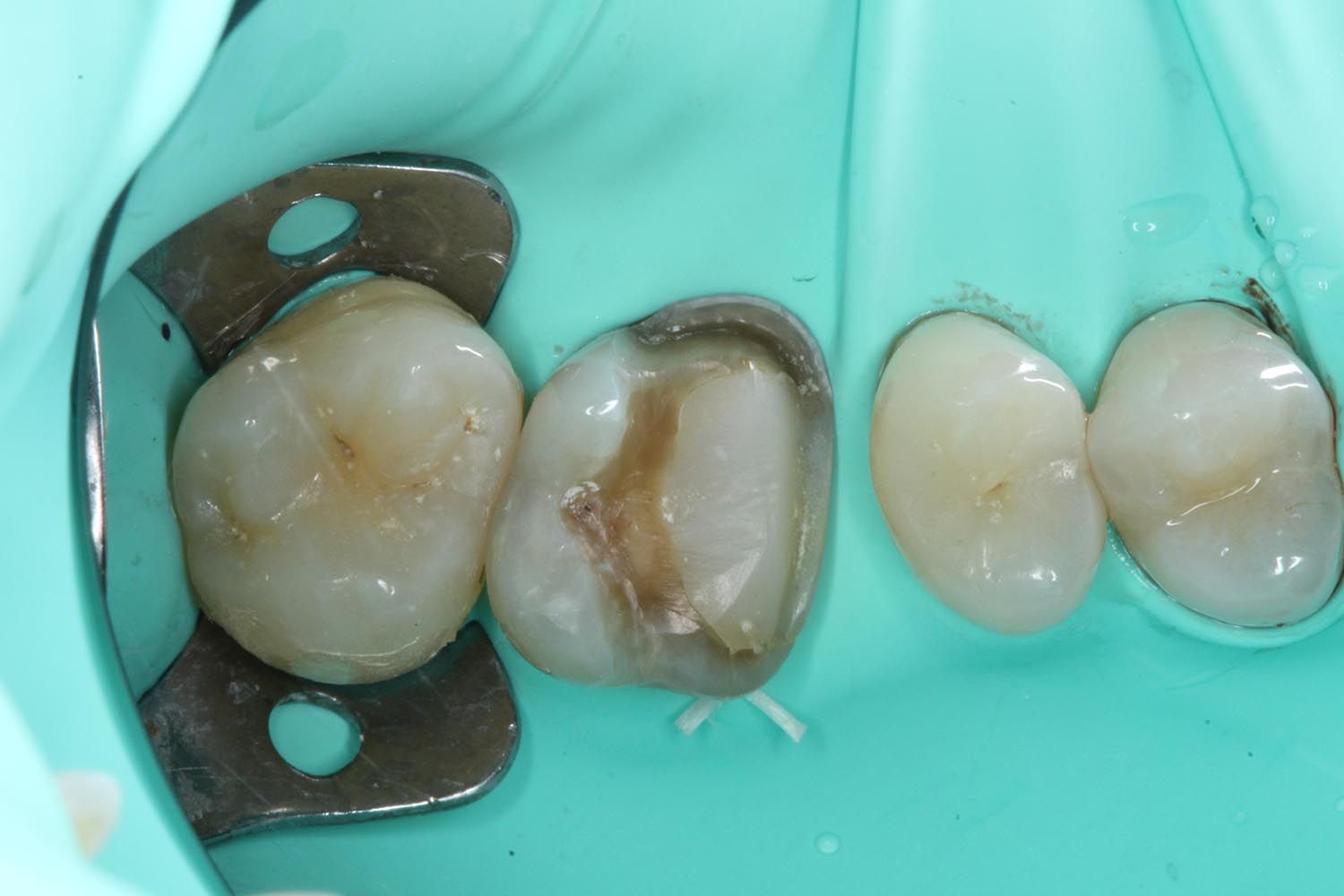 Primo piano di denti isolati con una diga di gomma, che mostra un morsetto metallico scuro e i molari trattati.