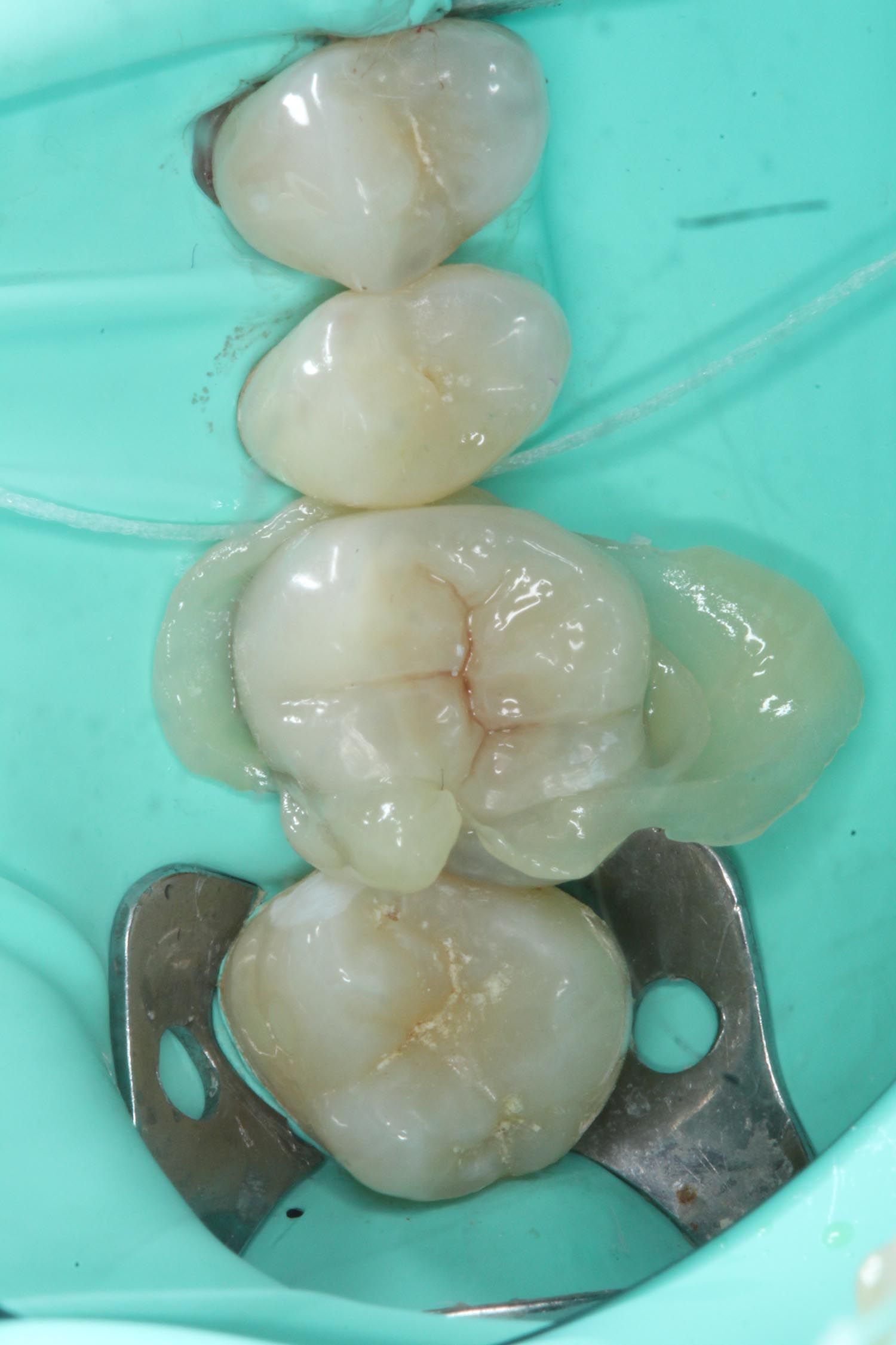 Primo piano di un trattamento odontoiatrico con denti isolati da una diga di gomma turchese.
