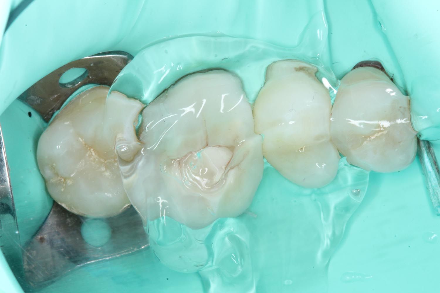 Primo piano di molari isolati con diga di gomma dentale verde durante una procedura odontoiatrica.