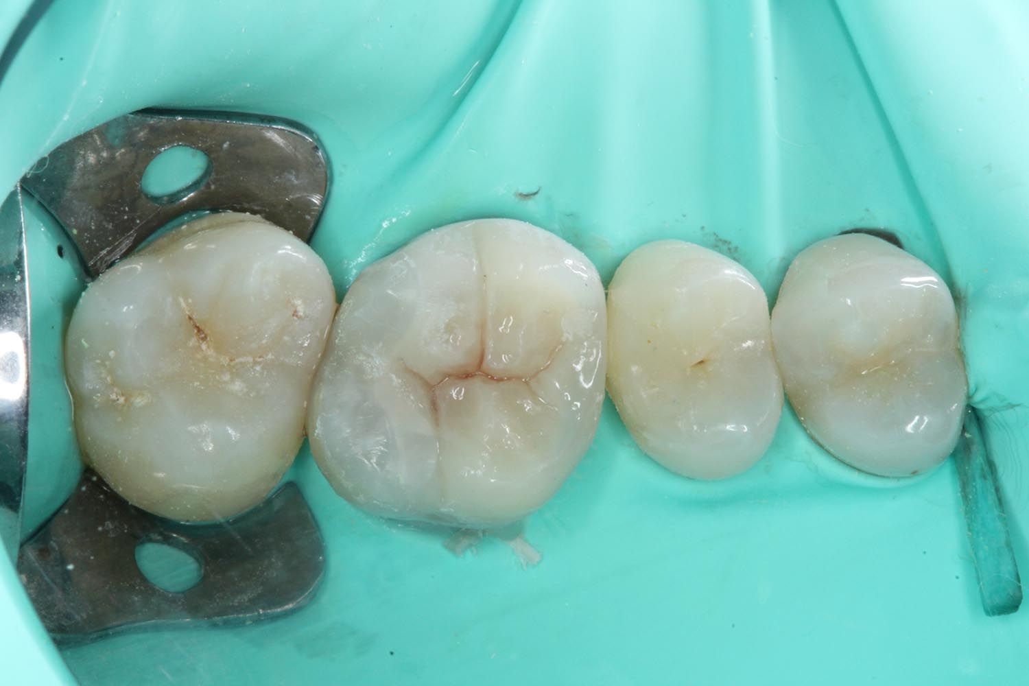 Primo piano di molari isolati con una diga di gomma dentale color verde acqua e un morsetto metallico.