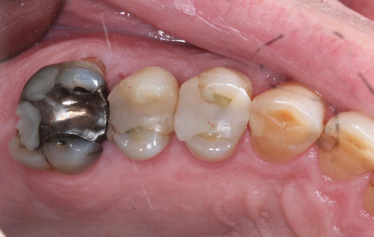 Primo piano di molari con otturazione in amalgama d'argento e denti macchiati in una bocca