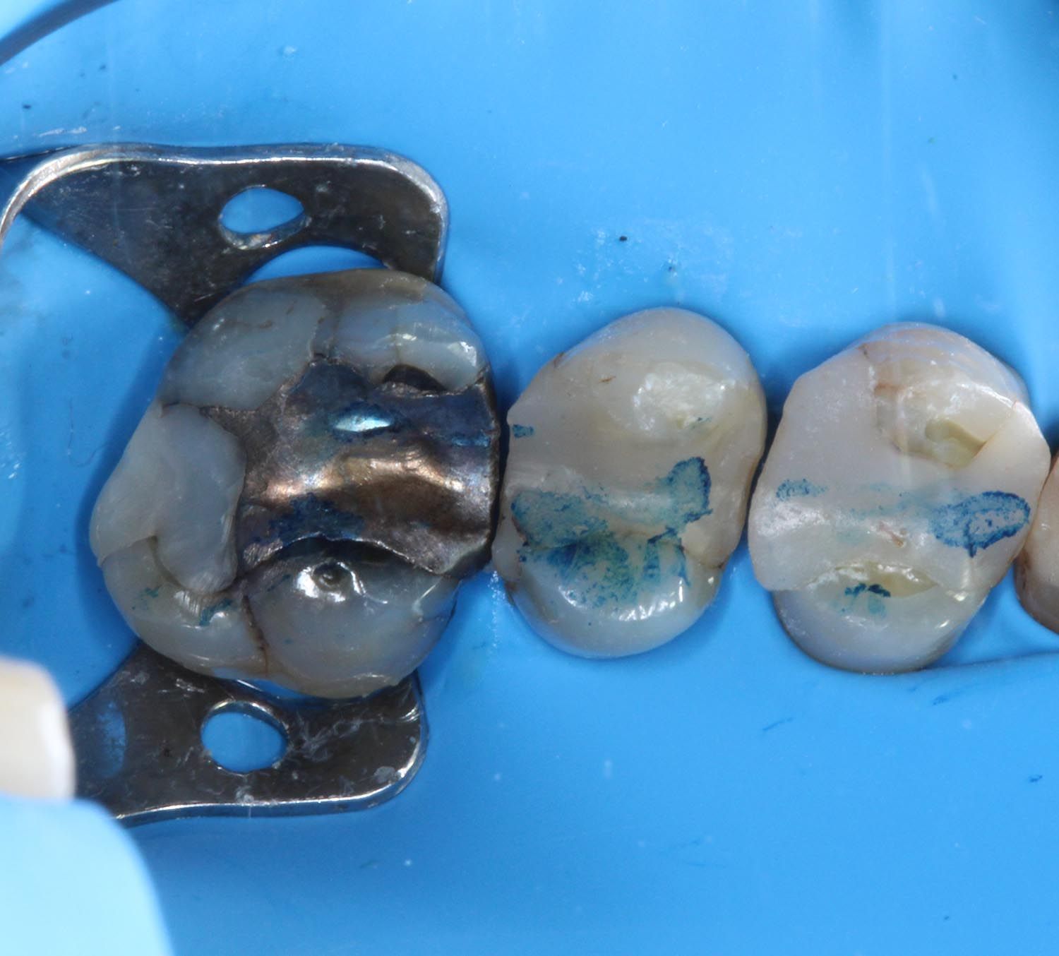 Primo piano di tre molari isolati con diga di gomma e morsetto metallico durante il trattamento.