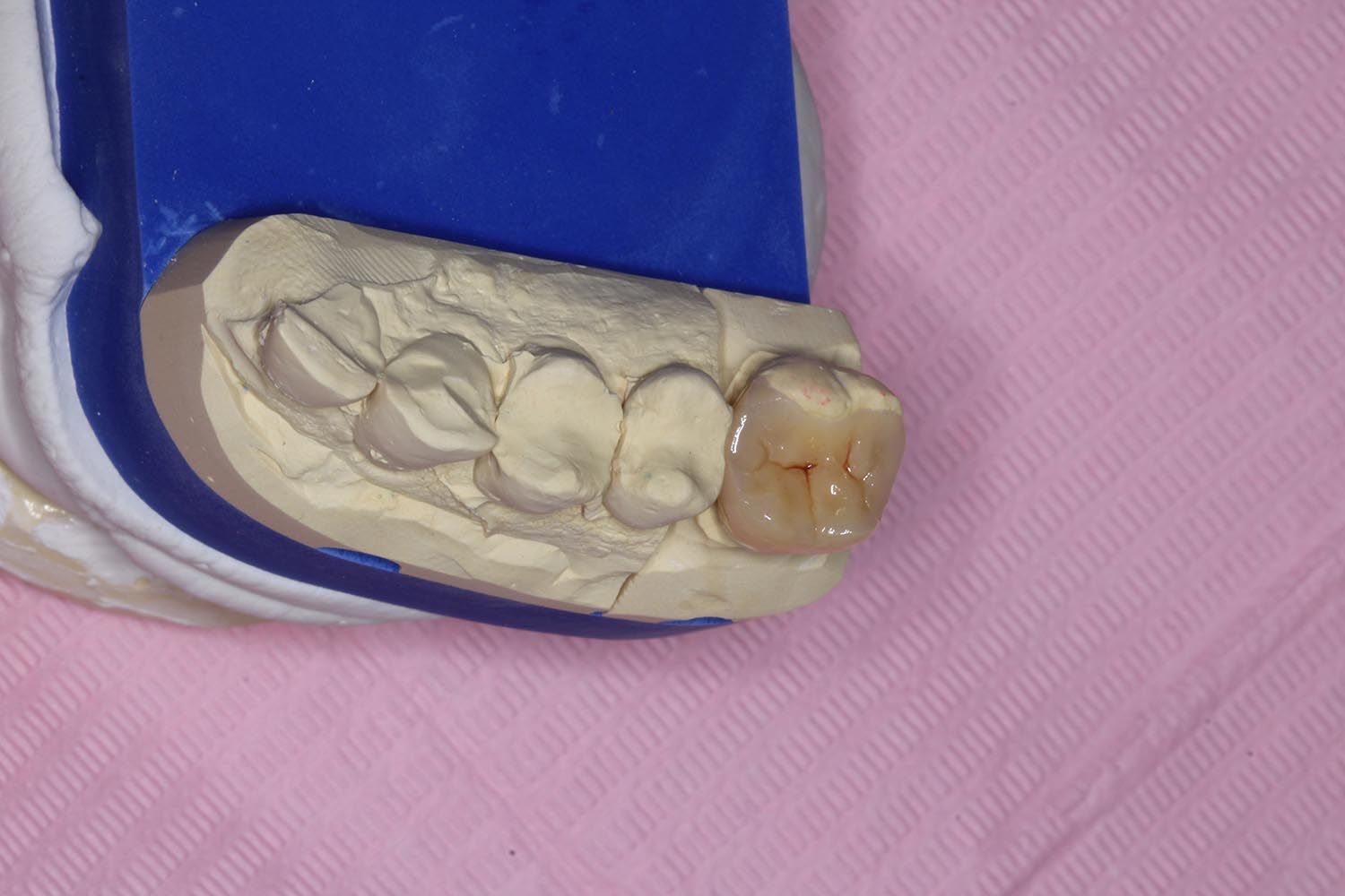Calco dentale in un vassoio blu con un singolo dente e sfondo rosa